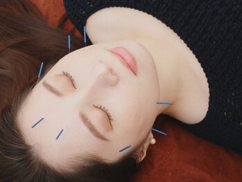 星の鍼灸接骨院/【美容鍼】