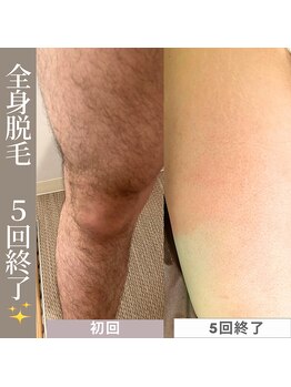 アカラビューティー(Akala Beauty)/全身脱毛〈５回終了！！〉
