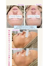 クレヴィー(Creviy)/3D毛穴洗浄×ハーブピーリング