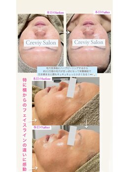 クレヴィー(Creviy)/3D毛穴洗浄×ハーブピーリング