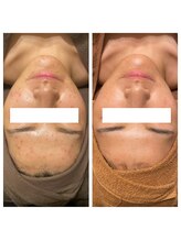 ビジュープラス 神栖店(Bijou+)/繰り返すニキビケア