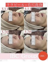 トータルサロンアイビーシー(トータルサロンIBC)/ララピール＋毛穴洗浄