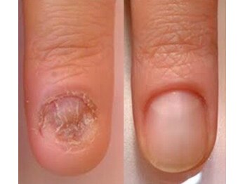 リファーレ(RIFARE)/【深爪矯正】爪が無くても大丈夫