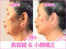 A1スポーツマッサージ治療院/【ビフォーアフター】美容鍼