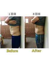 マリモ鍼灸接骨院/電磁パルス週1回8回目