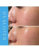 ハナイロ(hana-iro)/ヒアロテン管理