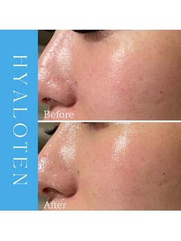 ハナイロ(hana-iro)/ヒアロテン管理