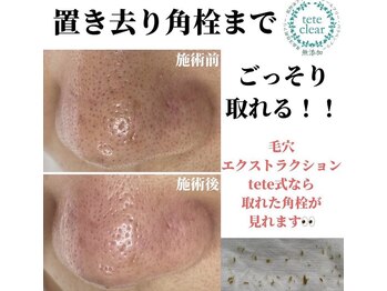 毛穴屋/毛穴洗浄毛穴エクストラクション