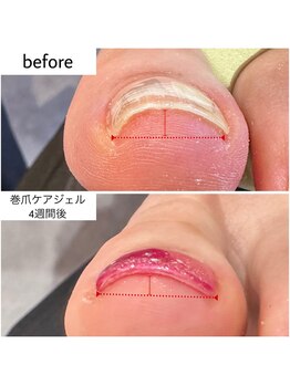 ケアプラス(care plus)/巻爪ケアジェル