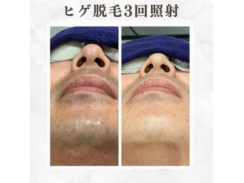 ボゴス 天白店(BOGOSS)/【ヒゲ脱毛】施術写真