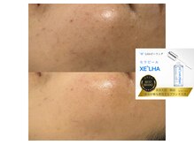 リシェリ 代官山(RICHERI)/ララピールの進化版！セラピール