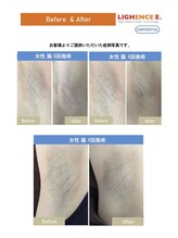 マル(MARU)/脱毛　～Before、After～