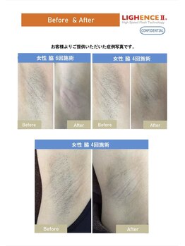 マル(MARU)/脱毛　～Before、After～