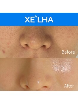 チャンティック(Cantik)/セラピール施術結果