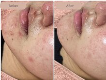 ゆらり/ニキビケア