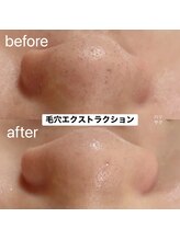 ハリサク/初回施術