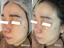 プティ 横浜店(Petit)/ハーブピーリング