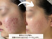 ベクラ 名古屋店(Becla)の雰囲気(肌質に合わせた正しいケアをすることでニキビ肌を卒業◎)