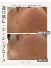 ラシュール(la sur)/シミ効果写真！