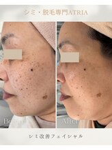 アトリア(ATRIA)/シミ改善フェイシャル