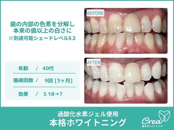 クレア(Crea)/【ホワイトニング症例写真】