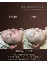レディラック 大阪梅田本店(Lady Luck)/ニキビ改善集中コース