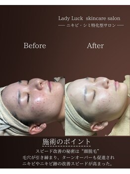 レディラック 大阪梅田本店(Lady Luck)/ニキビ改善集中コース