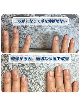 桃の木 吉祥寺店/二枚爪の原因は乾燥の事が多い