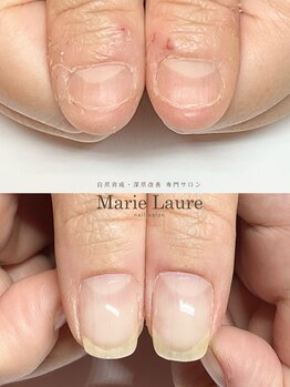 マリーロール 梅田店(Marie Laure)/自爪育成/深爪矯正/ネイルケア