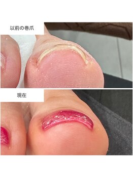 ケアプラス(care plus)/巻爪ケアジェル