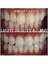 ライトビューティー 本八幡店(LIGHT BEAUTY)/1年後の白い歯のメンテナンス♪