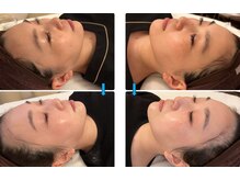 ファルファラ(farfara)/天然ハーブピーリング 