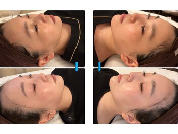 ファルファラ(farfara)/天然ハーブピーリング 