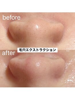 ハリサク/初回施術