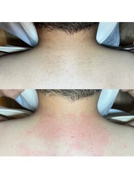 シーボウ(CBOU)/うなじの美容電気脱毛