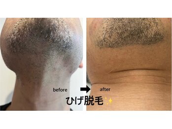 メディカルサロンドオフ 堺東店(medical salon de off)/メンズひげ脱毛★