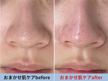 ミスターアンクール 鹿児島(Mr.uncoeur)/おまかせ肌ケア