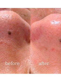 #美容革命ラボ 大阪南堀江店/毛穴洗浄ハイドラフェイシャル