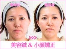 A1スポーツマッサージ治療院/【ビフォーアフター】美容鍼