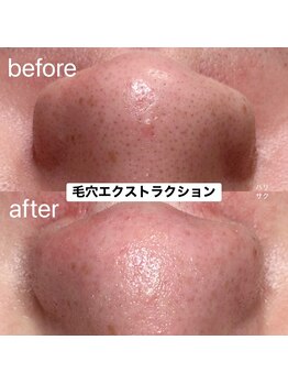 ハリサク/初回施術