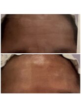 ダリア(DALIA)/おでこのシワにもエンビロン