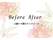 キレイ(KIREI)/小顔ハリ弾力アップコース