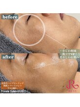 ハグ(HUG)/REVI陶肌トリートメント