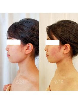 ミールーム(mi room)/フェイシャルマシン、小顔２回