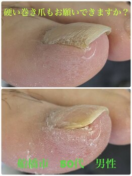 巻き爪じゅん 千葉駅前店/硬い巻き爪も変われる？