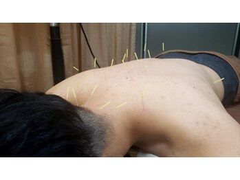 アラキ(ARAKI)/肩こり鍼灸施術うけてみませんか