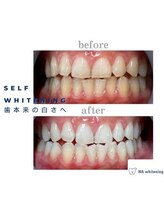 NAホワイトニング 自由が丘店/【before/after】
