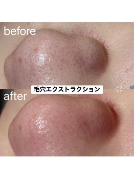 ハリサク/初回施術