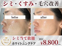 パールホワイトニング
