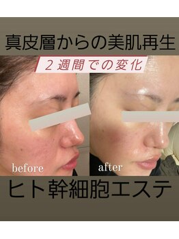 ココ(COCO)/【再生美容】ヒト幹細導入